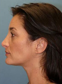 Rhinoplasty Before & After Image