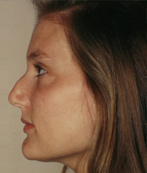 Rhinoplasty Before & After Image