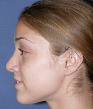 Rhinoplasty Before & After Image