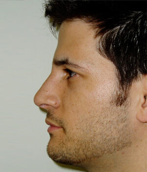 Rhinoplasty Before & After Image