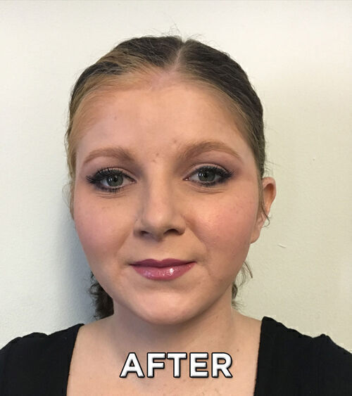 Rhinoplasty Before & After Image