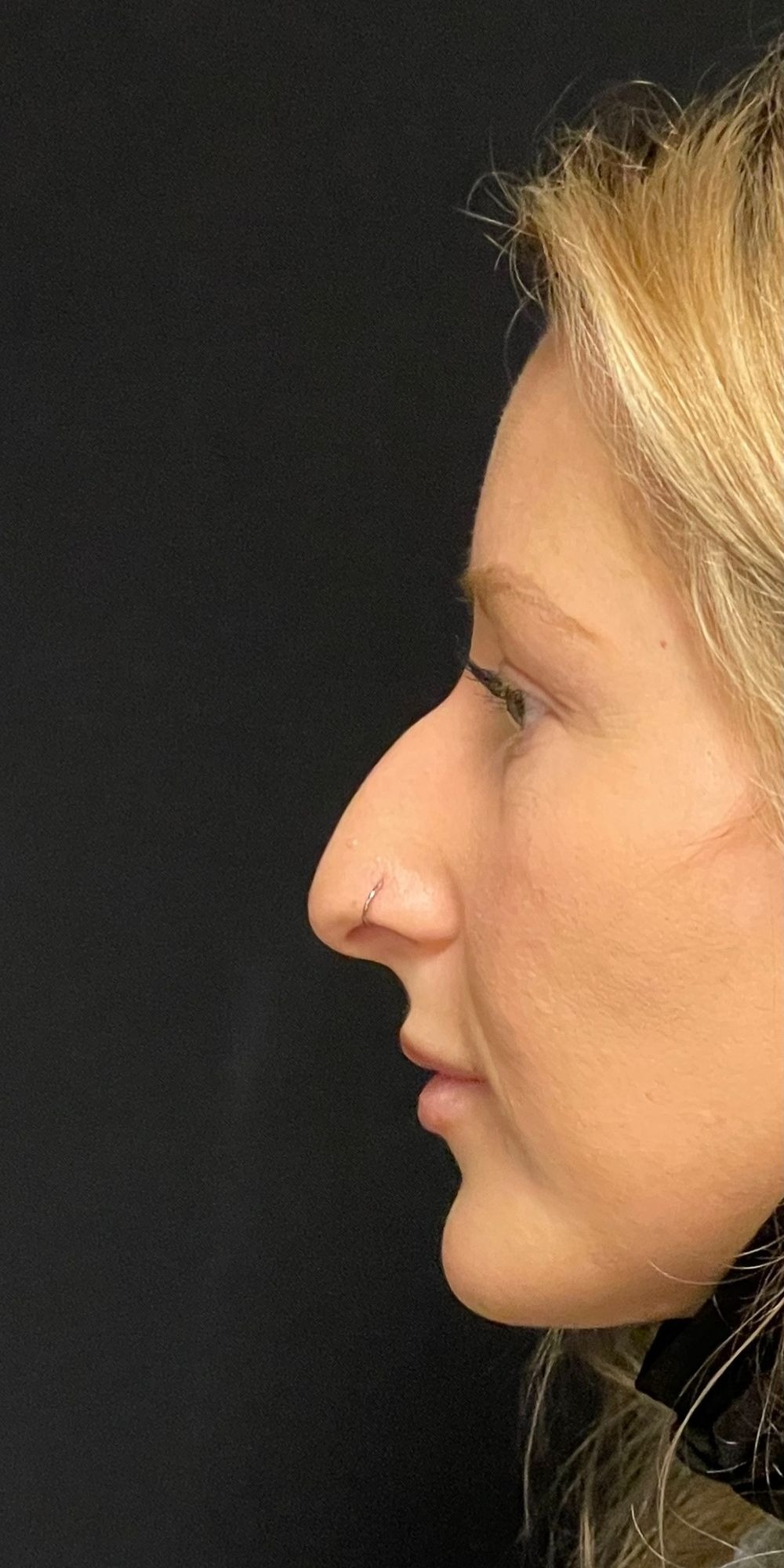 Rhinoplasty Before & After Image