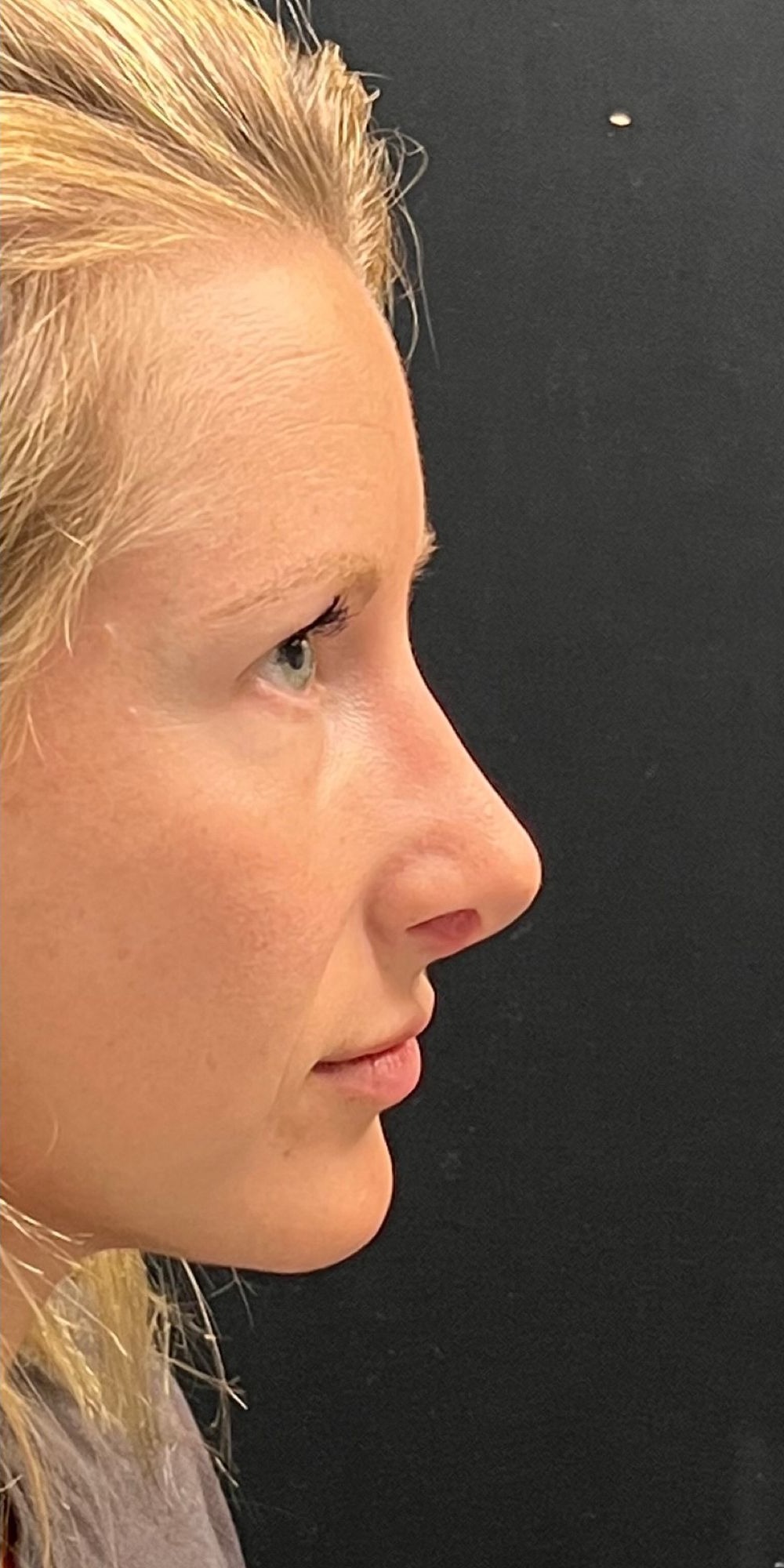 Rhinoplasty Before & After Image