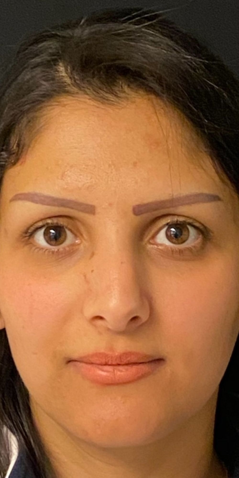 Rhinoplasty Before & After Image