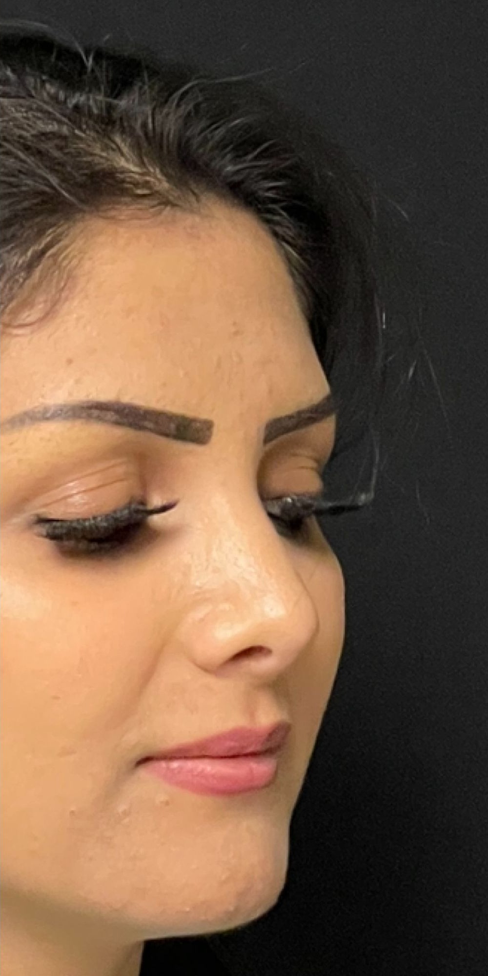 Rhinoplasty Before & After Image