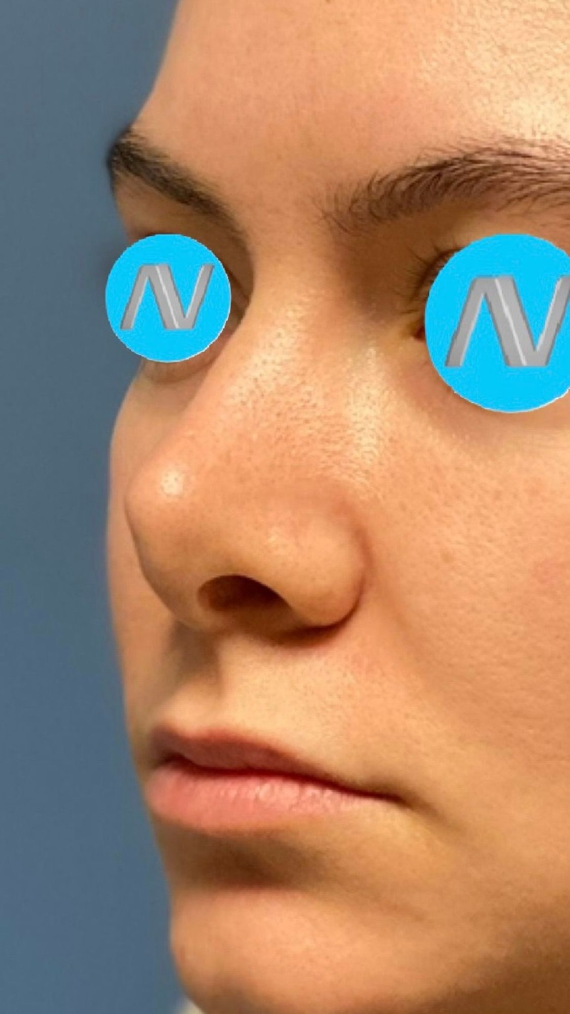 Rhinoplasty Before & After Image