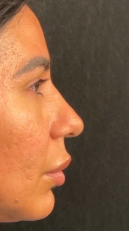 Rhinoplasty Before & After Image