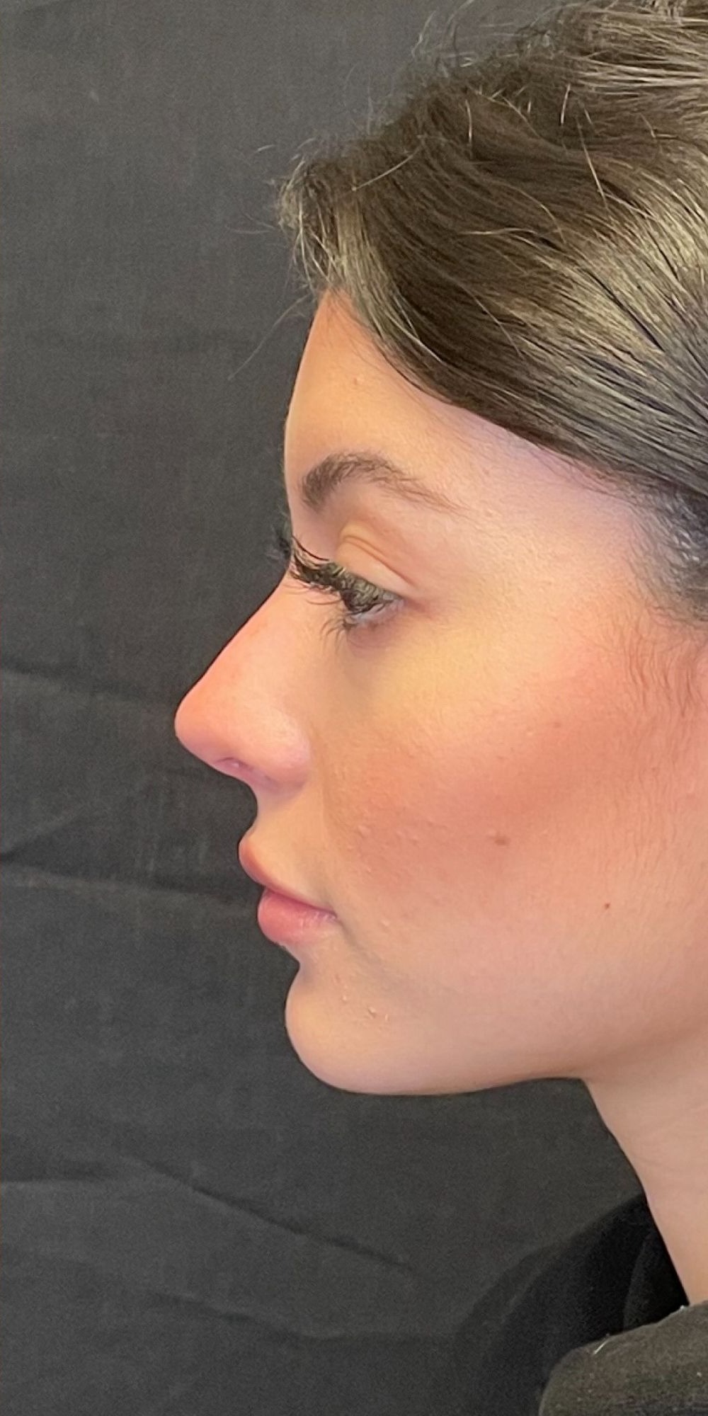 Rhinoplasty Before & After Image