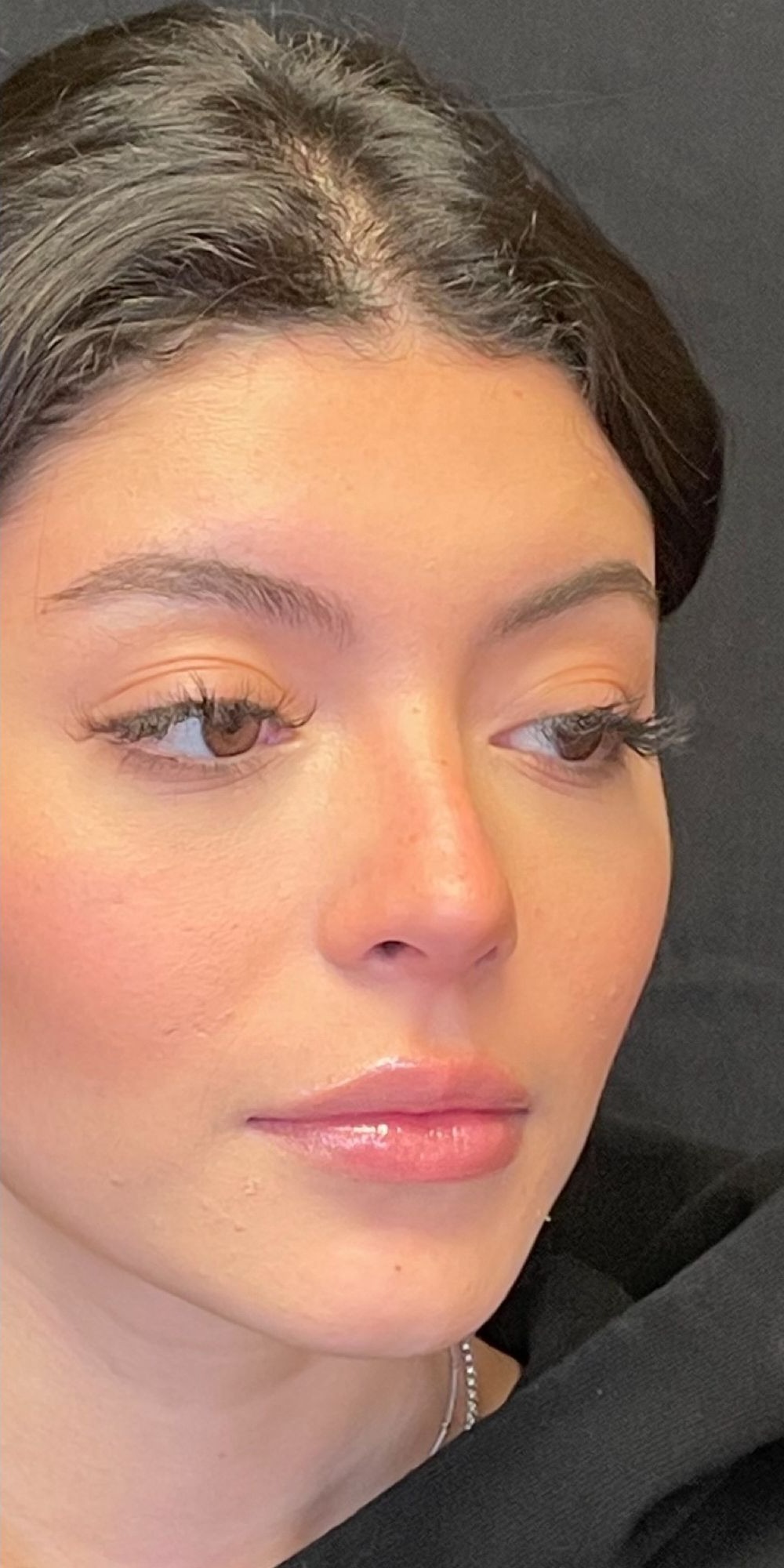 Rhinoplasty Before & After Image